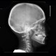 Fibrous dysplasia of the left maxillary sinus: X-ray - Plain radiograph